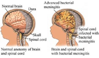 Normal brain vs. meningitis-affected brain