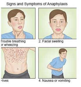 Signs and symptoms of anaphylaxis
