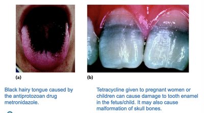 Side effects of antimicrobial drugs