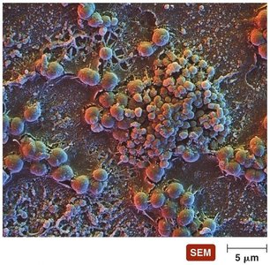 Biofilm on a human tooth (plaque)