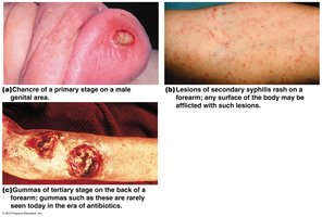Stages of syphilis: primary chancre, secondary rash, tertiary gummas