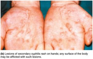 Secondary syphilis rash on hands