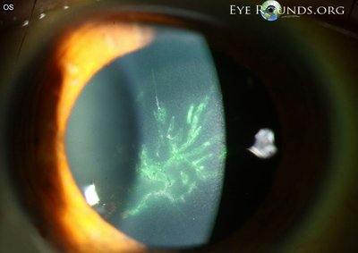 Fluorescein staining showing dendritic lesion in herpetic keratitis
