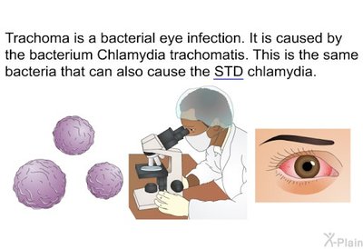 Trachoma: Chlamydia trachomatis infection and clinical signs