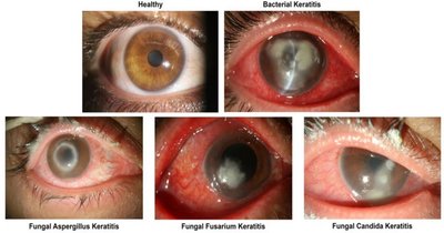 Severe keratitis with corneal opacity and inflammation