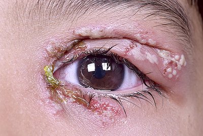 Herpetic keratitis: corneal involvement by HSV