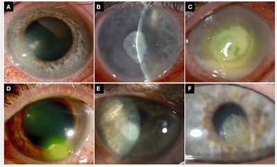 Clinical images of bacterial keratitis