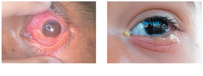 Comparison of viral and bacterial conjunctivitis: red eye and pus-like discharge