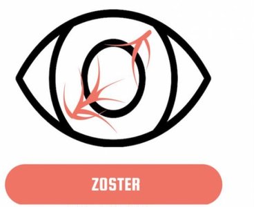 Diagram of zoster eye infection pattern