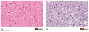 Brain tissue affected by prion disease