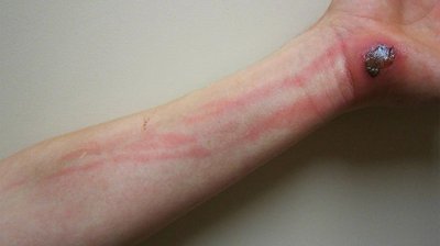 Lymphangitis as an example of focal infection
