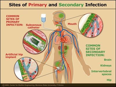 Sites of primary and secondary infection