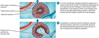 The Pathogenesis of Tuberculosis (2 of 2)