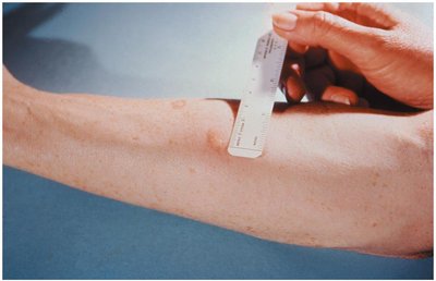 A Positive Tuberculin Skin Test on an Arm