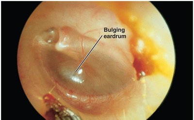 Acute Otitis Media, With Bulging Eardrum