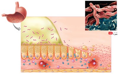 Helicobacter pylori infection and ulcer formation in the stomach wall