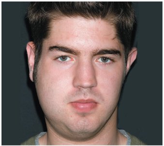 Clinical presentation of mumps (swollen parotid glands)