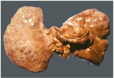 Damaged liver due to hepatitis