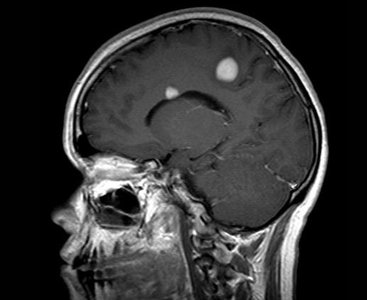 Neurocysticercosis: brain with cysts