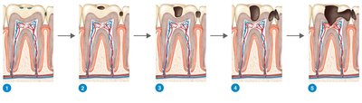 Stages of tooth decay from healthy tooth to advanced decay
