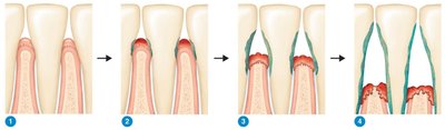 Stages of periodontal disease from healthy gingivae to periodontitis