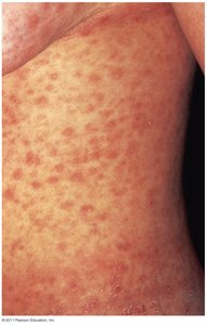 Roseola rash