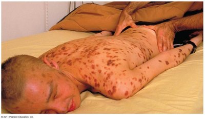 Kaposi's sarcoma lesions