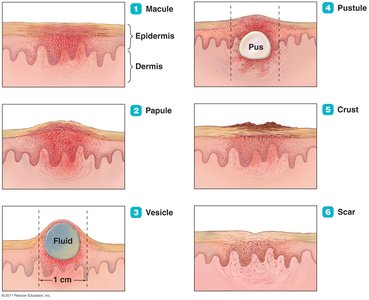 Stages of lesions in poxvirus infections