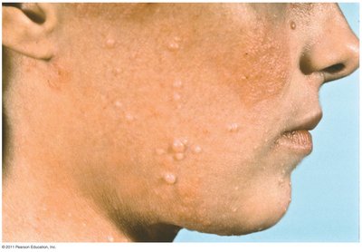Lesions of molluscum contagiosum