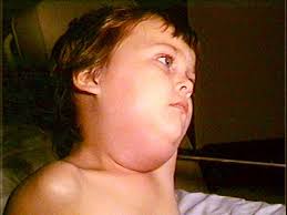 Swelling of the parotid gland in mumps