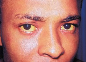 Jaundice in hepatitis