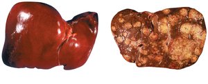 Comparison of healthy liver and liver with cirrhosis