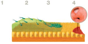 H. pylori colonization and ulcer formation in the stomach lining