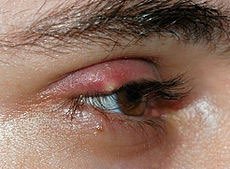 Sty (stye) on eyelid