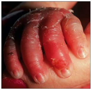 Scalded skin syndrome on hand