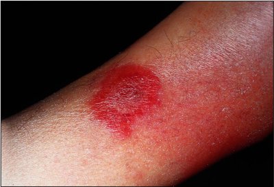 Impetigo: crusted lesions around mouth