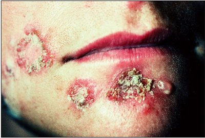 Necrotizing fasciitis: severe tissue destruction