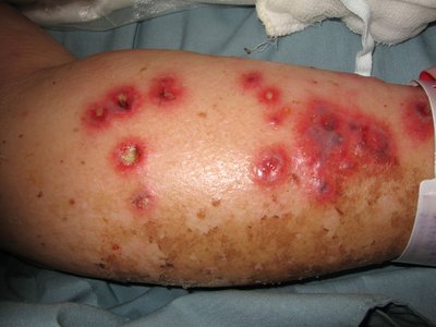 Inflammatory acne on face