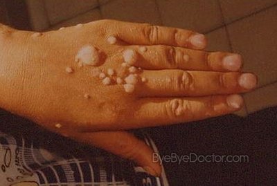 Epidermodysplasia verruciformis (tree man disease)