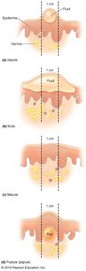 Diagram of different types of skin lesions