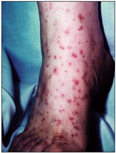 Hemorrhagic rash of Rocky Mountain Spotted Fever
