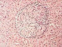 Hepatic granuloma in brucellosis