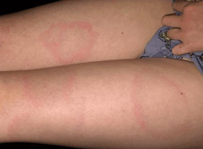Erythema migrans (bull's-eye rash) in Lyme disease