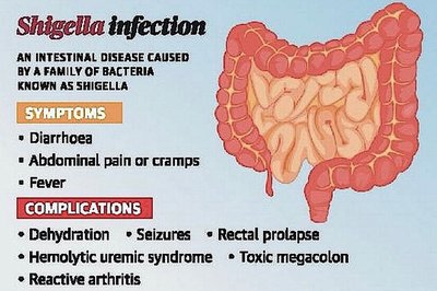 Symptoms and complications of Shigella infection