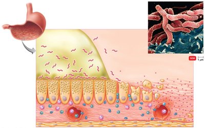 Helicobacter pylori infection and mucosal disruption in the stomach
