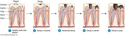 Progression of dental caries from plaque to pulp involvement
