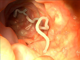 Tapeworm infected colon