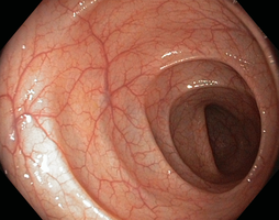 Normal colon