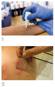 Skin prick test for allergies