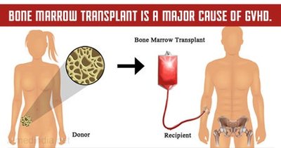 Bone marrow transplant and GVHD
